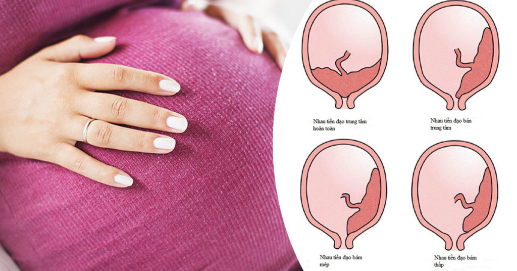 Biến chứng thai kỳ mẹ có thể gặp Nhau tiền đạo trung tâm