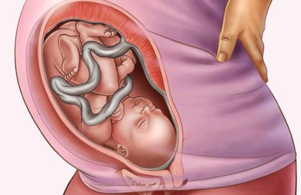 Em bé bị dây rốn quấn cổ phải làm sao