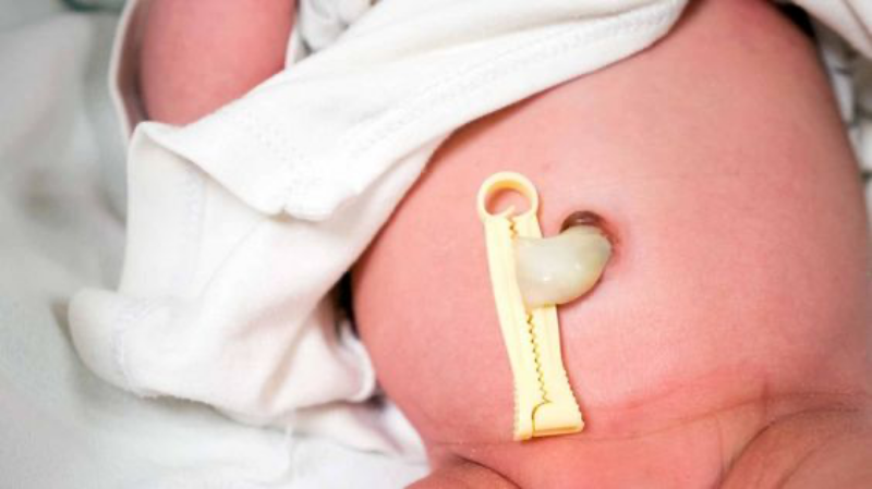 Một số vấn đề thường gặp về rốn ở trẻ sơ sinh