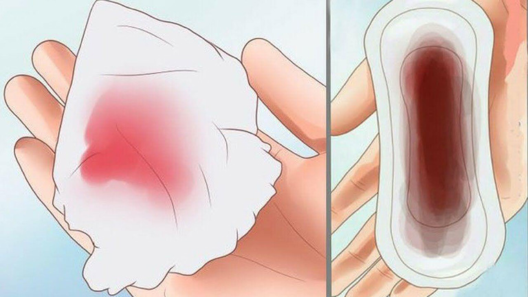 Sản dịch sau sinh là gì