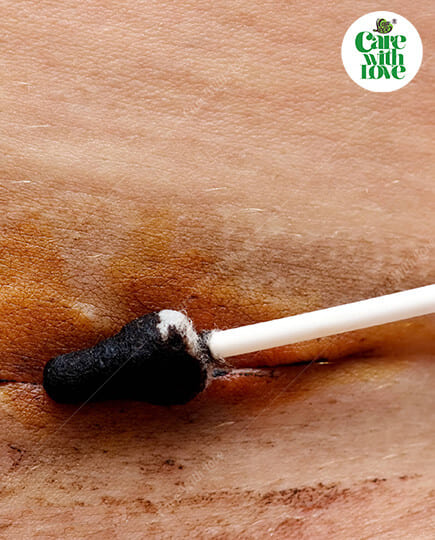 chăm sóc vết mổ sau sinh