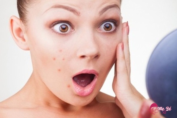 Nếu bạn đã từng bị mụn trứng cá trước đây thì nguy cơ mụn trong thai kỳ là rất lớn.