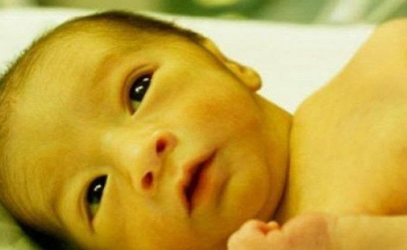 Tìm hiểu kỹ về bệnh vàng da để chăm sóc con kỹ càng hơn