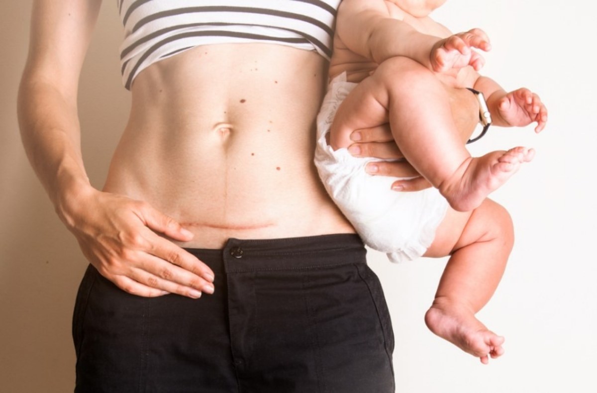 Sau sinh mổ, mẹ nên vận động nhẹ và tăng dần theo khả năng phục hồi của cơ thể