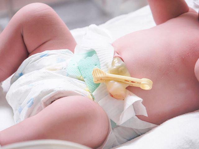 Những nguy hiểm của nhiễm trùng rốn ở trẻ sơ sinh