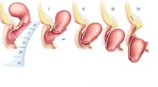 dấu hiệu sa da con sau sinh