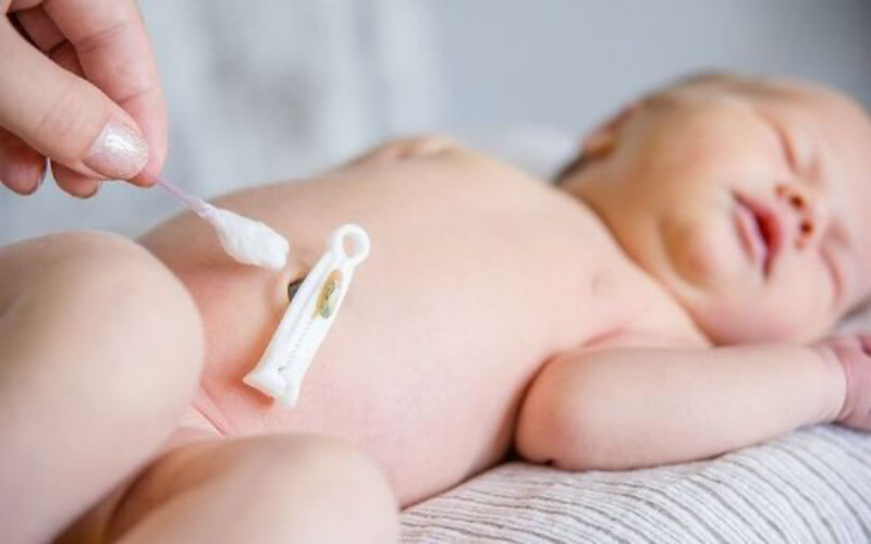 Chăm sóc rốn trẻ sơ sinh trước khi rụng