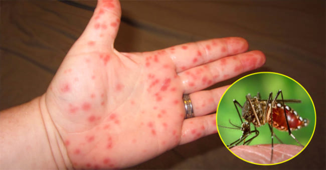 Phát ban là một trong những dấu hiệu của sốt xuất huyết
