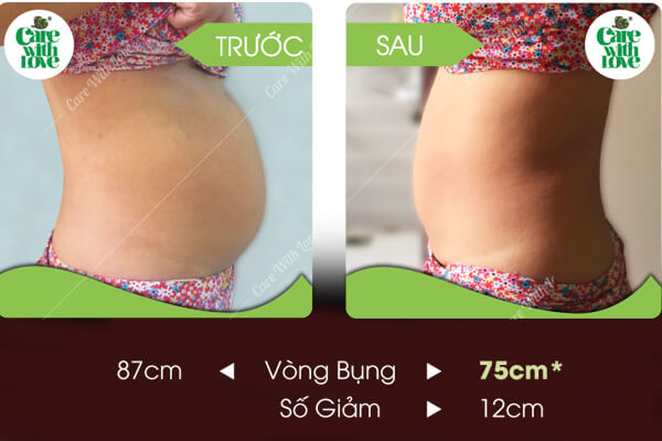 giảm eo sau sinh