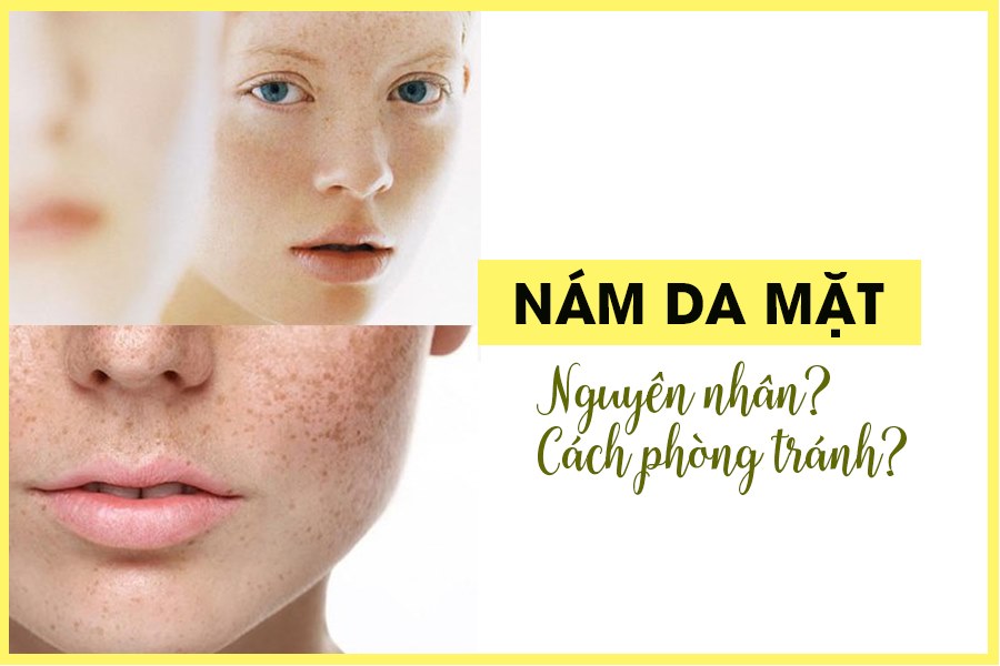 NGUYÊN NHÂN GÂY NÁM TRÊN DA MẸ BẦU