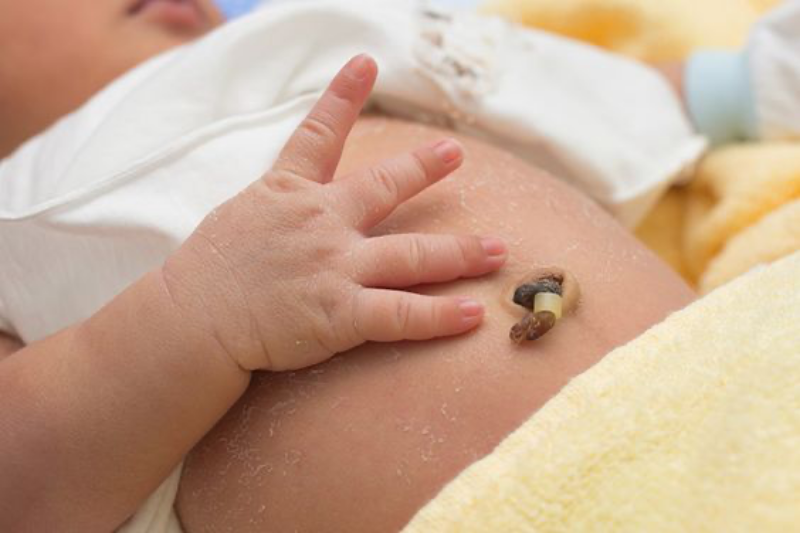 Tình trạng rốn rỉ dịch cũng thể hiện bé đang gặp vấn đề