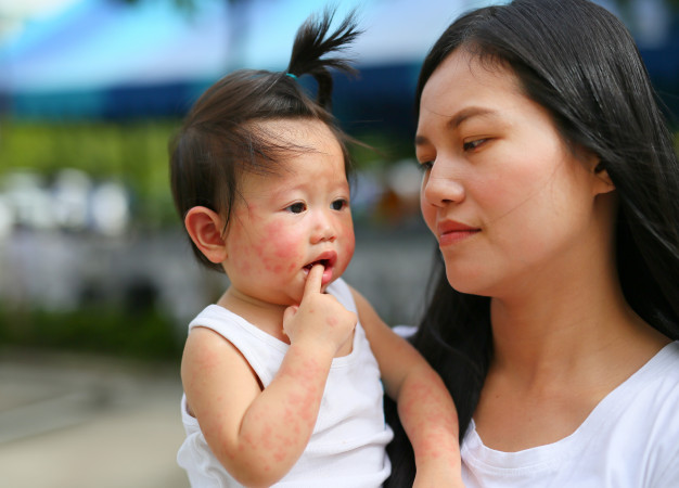 Trẻ bị rôm sảy