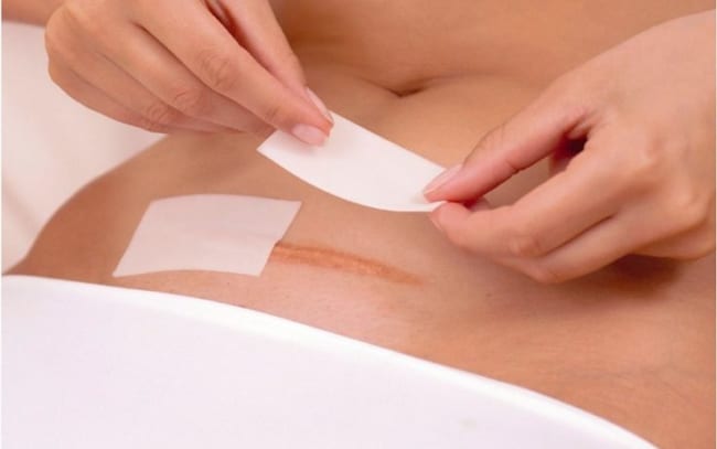Giảm đau cho vết thương mổ và âm đạo