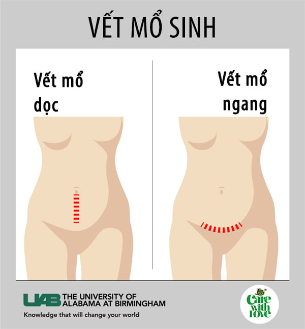 Để chuẩn bị tâm lý và thể chất trước khi sinh mổ, các mẹ bầu cần tìm hiểu về 2 phương pháp mổ sinh là mổ sinh ngang và mổ sinh dọc