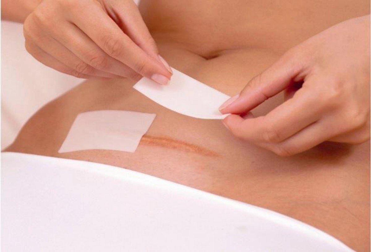 Chăm sóc vết mổ đúng cách giúp hỗ trợ quá trình lành thương sau sinh
